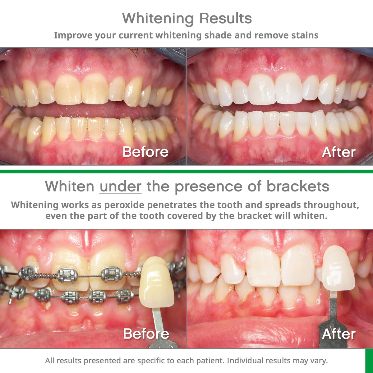 10% Hydrogen Peroxide Teeth Whitening Trays Y492